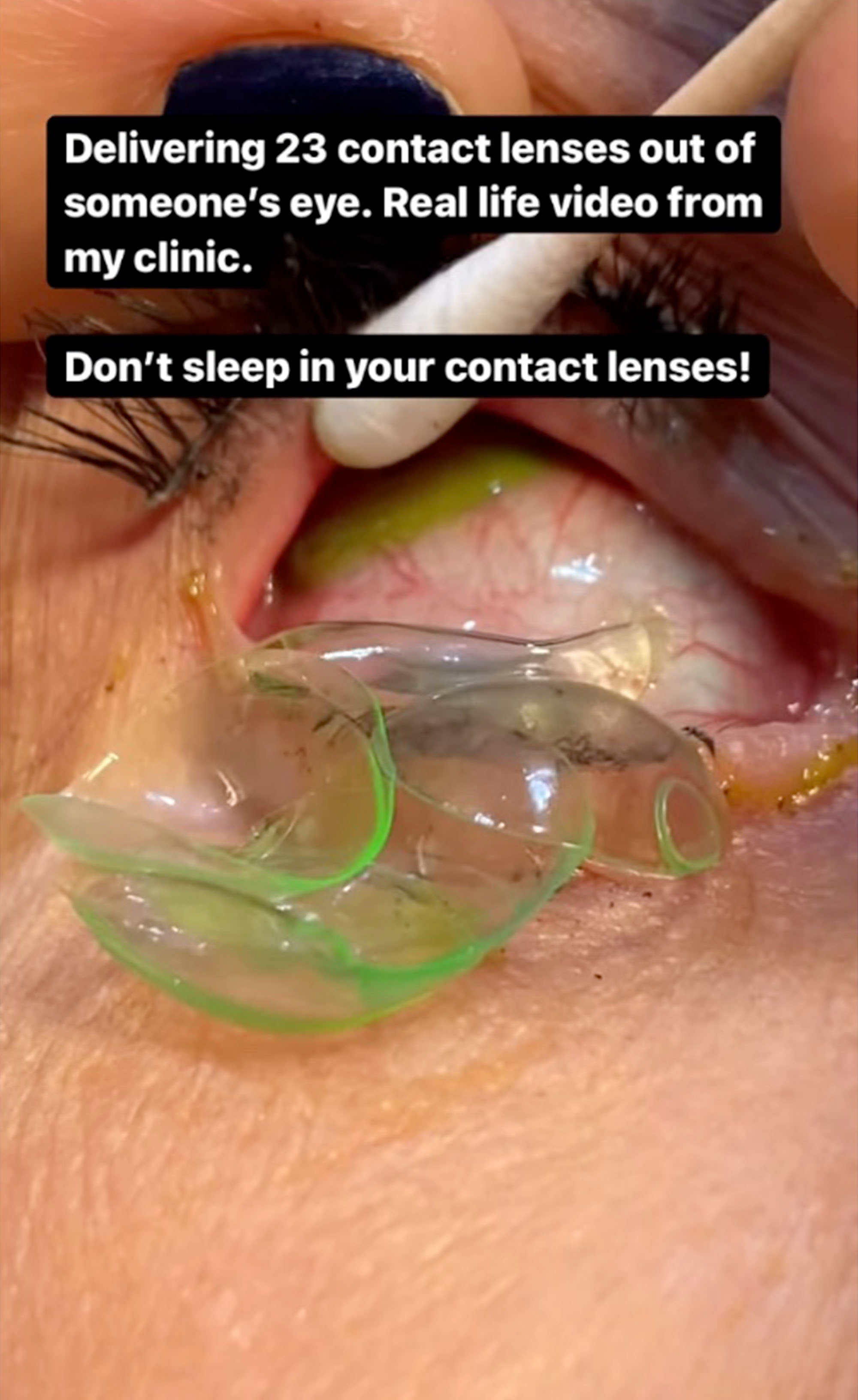 [IMG: The lump of contact lenses, from her video]